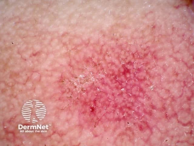 Dermoscopic photograph of facial actinic keratosis showing a strawberry pattern