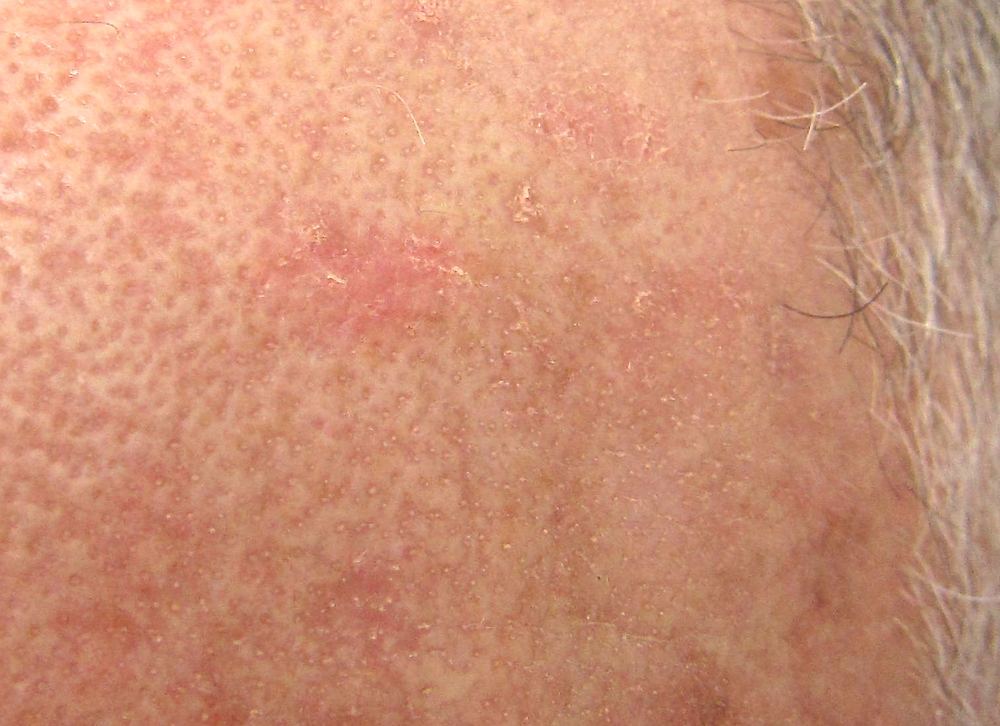 Close clinical photograph of a rough scaly actinic keratosis