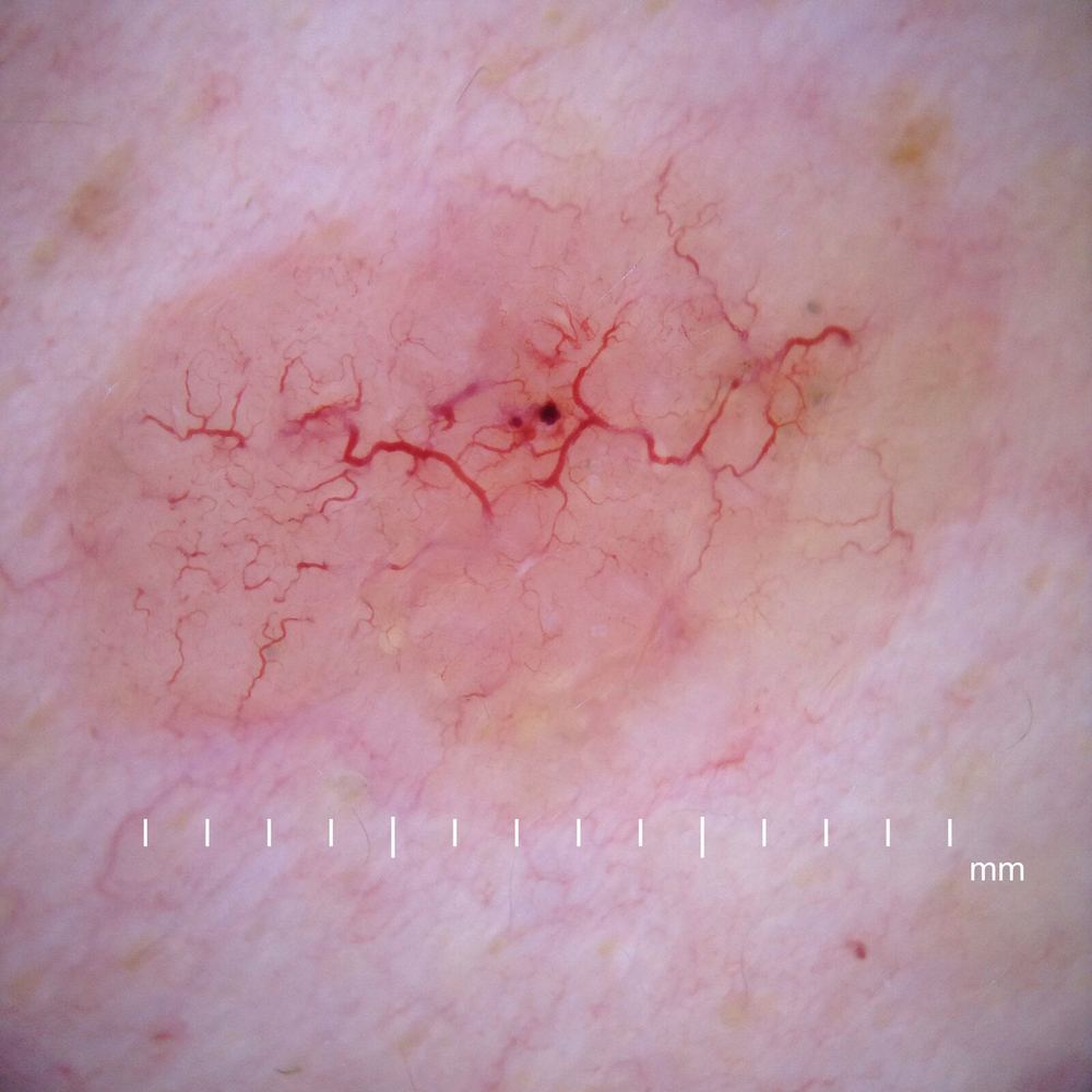 Dermoscopic view of a nodular basal cell carcinoma showing branching blood vessels