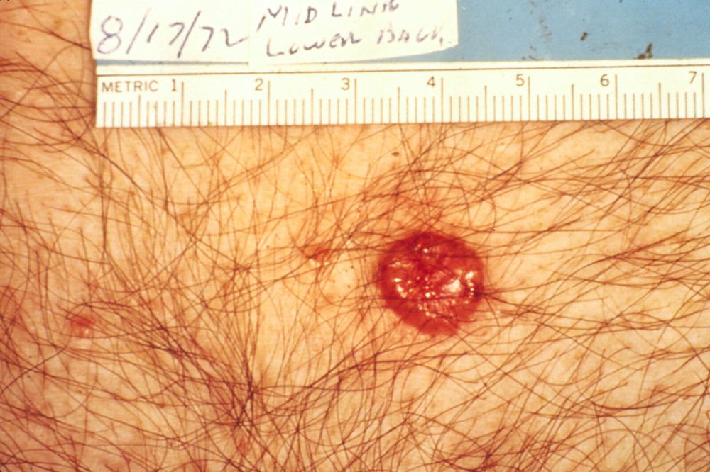 Clinical photograph of a basal cell carcinoma