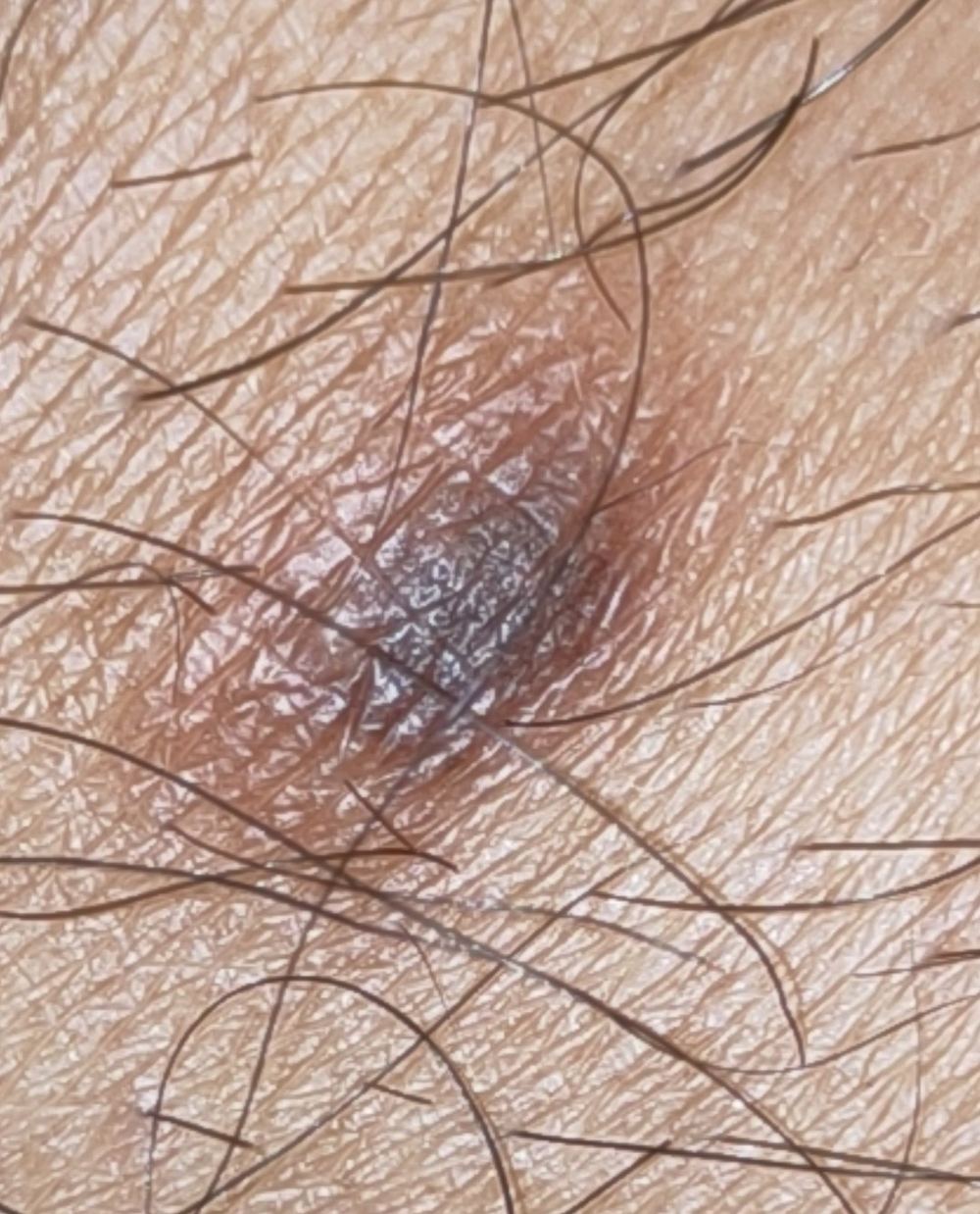 Representative clinical photograph of Dermatofibroma
