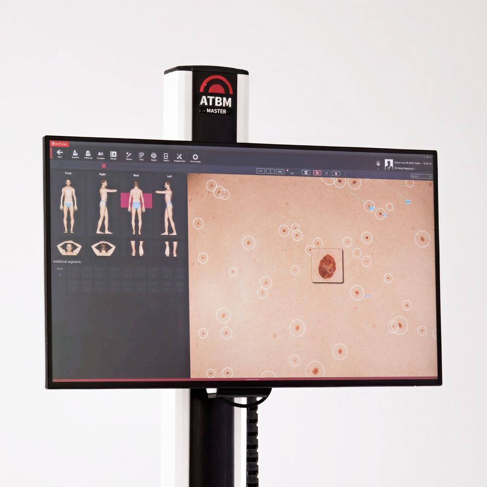 FotoFinder ATBM master system displaying total-body mapping and computer-assisted identification of skin lesions