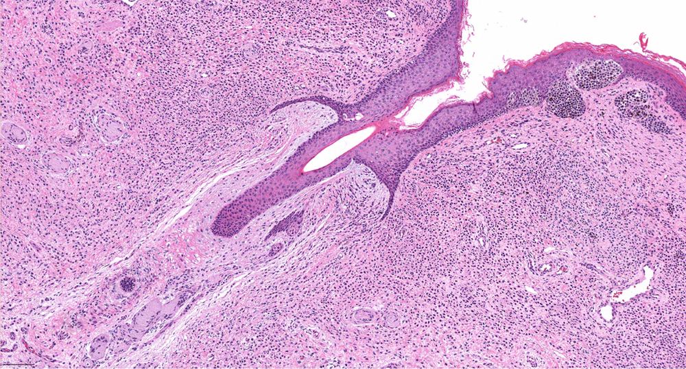 Representative clinical photograph of Melanocytic naevus