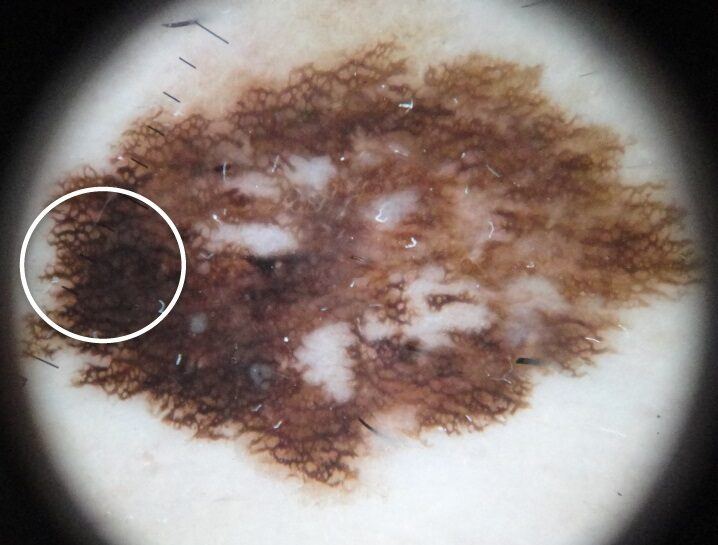 Dermoscopic photograph of superficial spreading melanoma in situ showing an atypical broadened pigment network