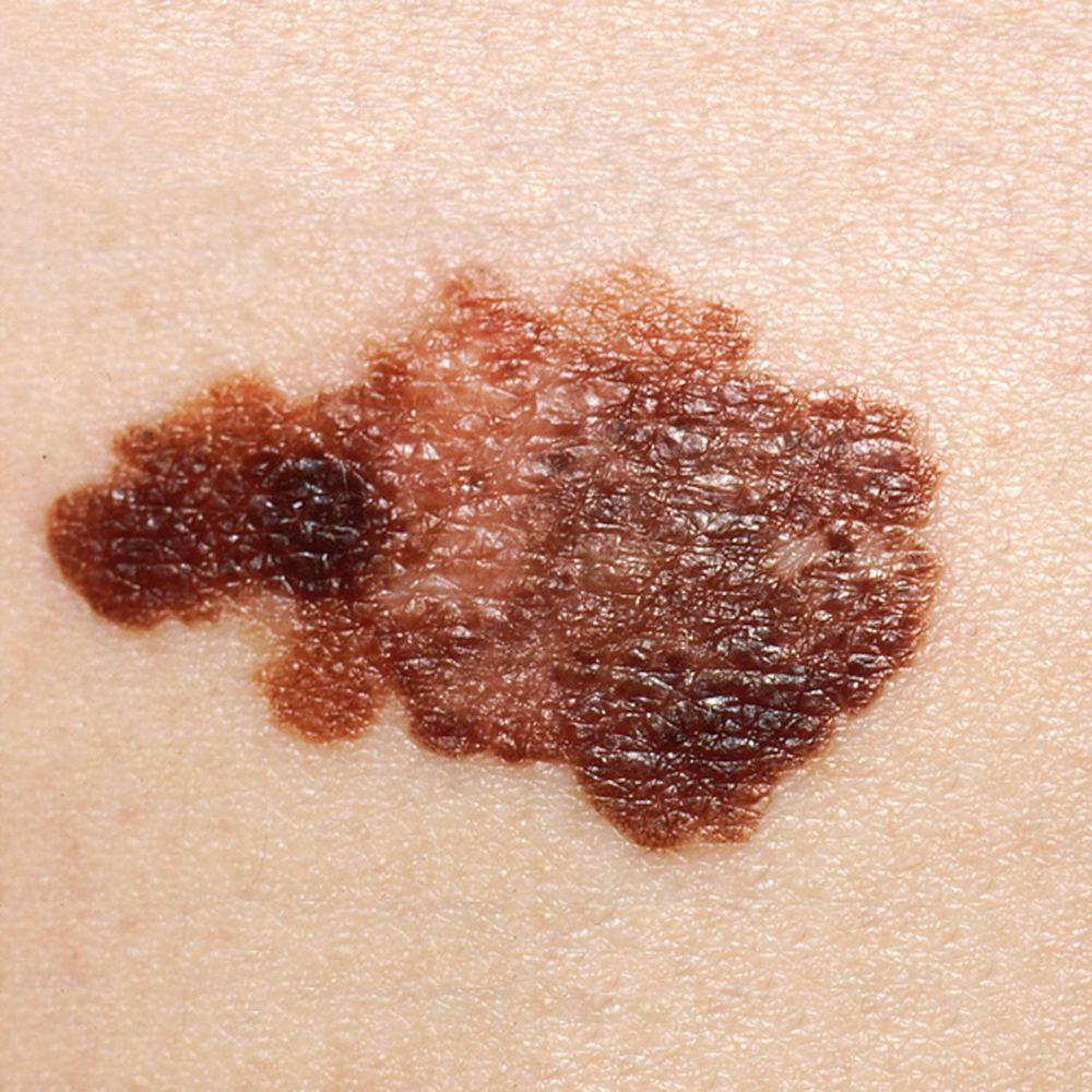 Clinical photograph of melanoma with asymmetry, an irregular border and varied pigmentation