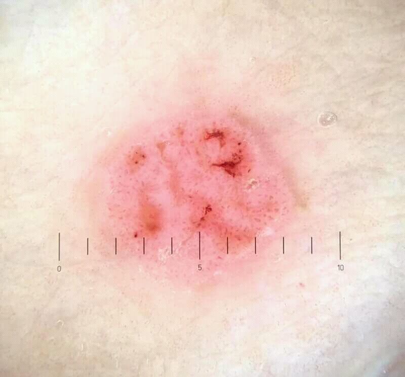 Dermoscopic photograph of squamous cell carcinoma in situ, also called Bowen disease