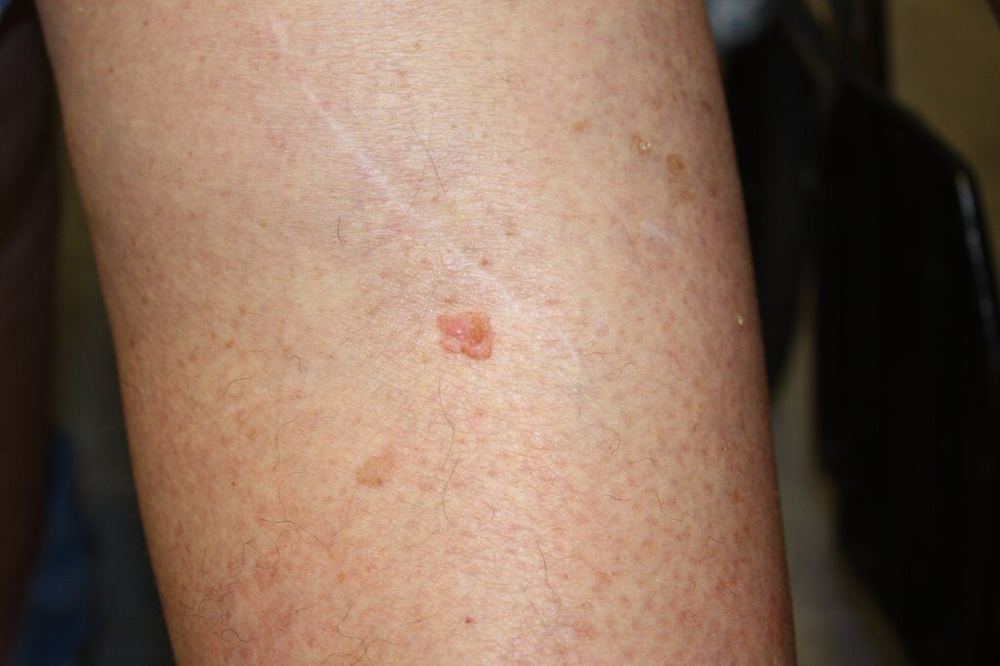 Clinical photograph of a small pink raised squamous cell carcinoma on the leg
