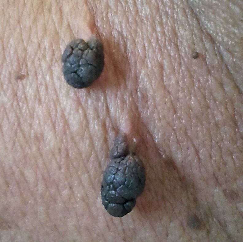 Representative clinical photograph of Skin tag