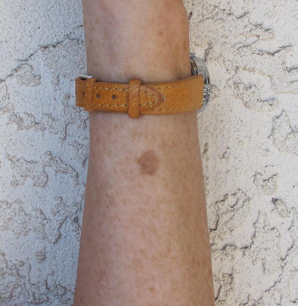 Representative clinical photograph of Solar lentigo