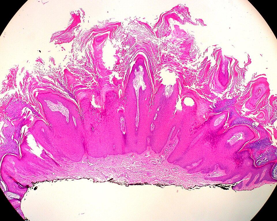 Representative clinical photograph of Viral wart